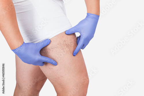 Man in blue gloves shows the dilation of small blood vessels of the skin on the leg. Medical inspection and treatment of Telangiectasia. Phlebeurysm.