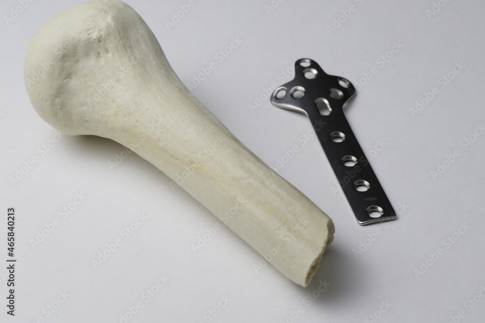 Surgical plates for osteosynthesis in case of bone fractures StockFoto