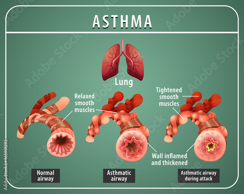Asthma diagram with normal airway and asthmatic airway