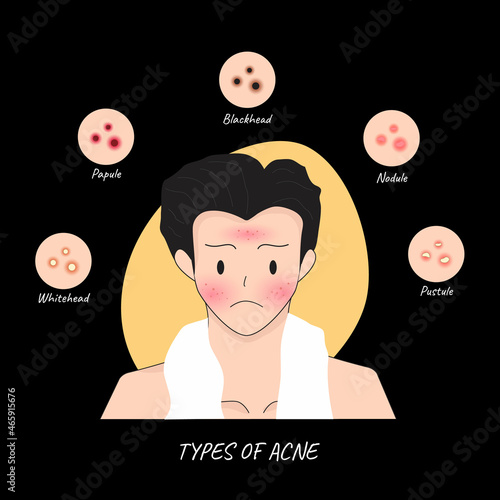 Illustrations Types of acne occur on a man Face