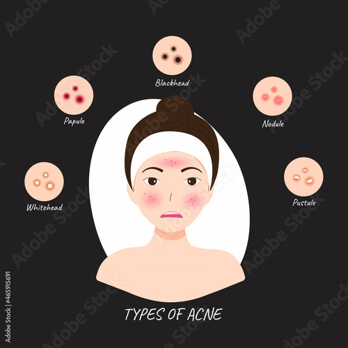 Illustrations Types of acne occur on a Woman Face