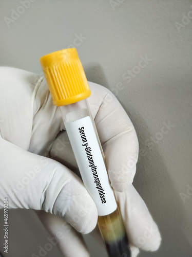Blood sample for y-Glutamyl transpeptidase(yGT) test, Liver enzyme photo