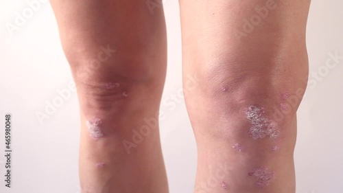 Knee joint effusion.Psoriatic arthritis, meniscus injury.Excess synovial fluid in and around the left knee joint on white background.Close up photo