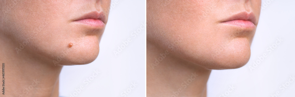 Woman face before and after mole removal. Laser treatment for birthmark removal from patient's face. Woman face before and after mole removal. Laser treatment for birthmark removal from patient's face.