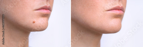 Woman face before and after mole removal. Laser treatment for birthmark removal from patient's face. photo