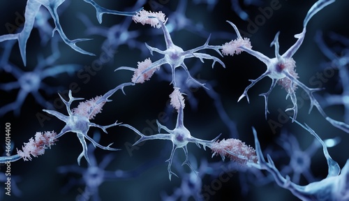 Amyloid plaques in Alzheimer's disease photo