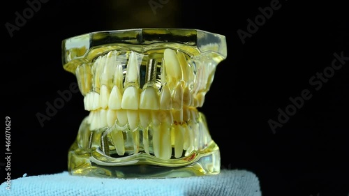 Close-up photo of implant dentistry it is a replacement for missing teeth by dentist hand.