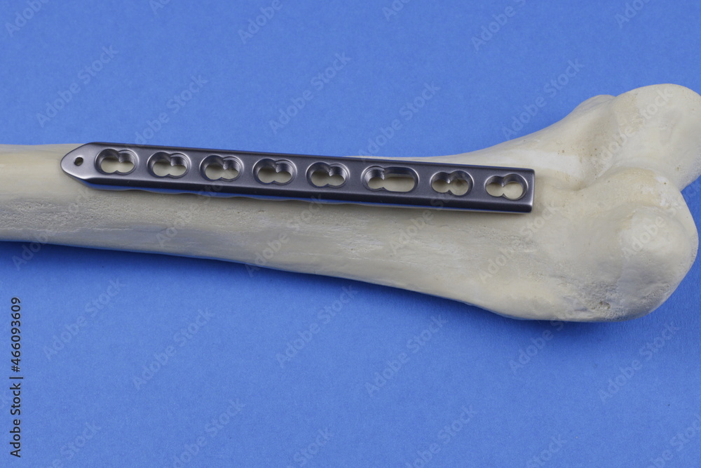 Surgical plates for osteosynthesis in case of bone fractures StockFoto