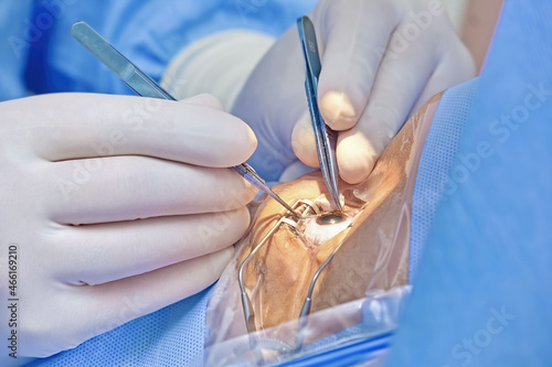eye surgery ophthalmology cataract phacoemulsification