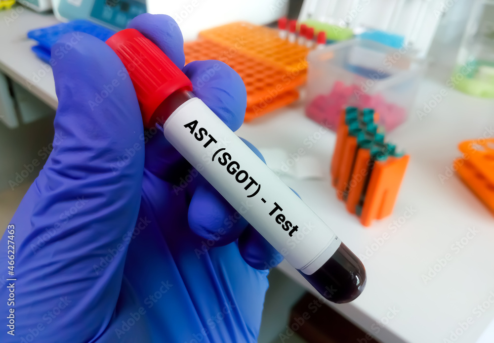 Blood sample isolated with copy space for AST (SGOT) Test. Liver