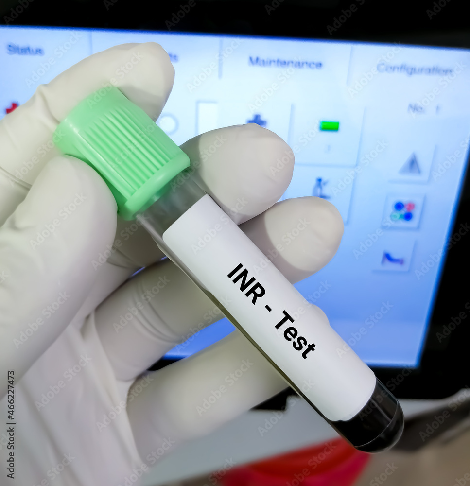 Blood sample for INR (International normalized ratio) test. Blood coagulation testing. PTT or PTT