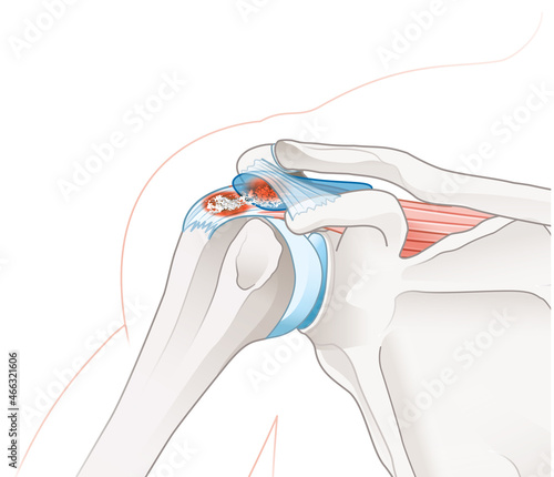 Shoulder joint. Calcific tendinitis and bursitis photo