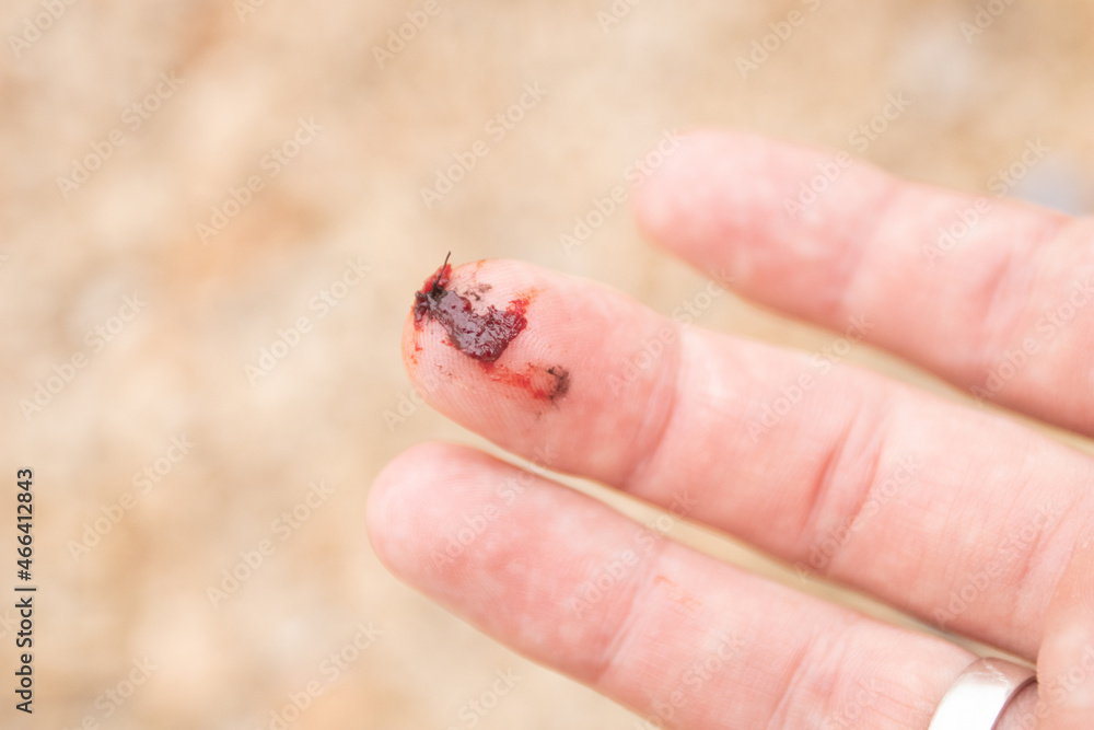 Injured finger with bleeding open cut