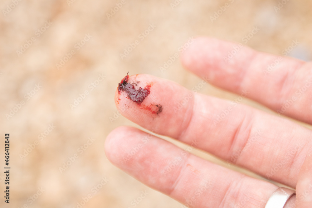 Obraz premium Injured finger with bleeding open cut