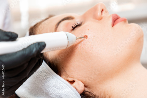 Professional salon procedures. Surgeon using a laser device for removing mole. Removal of birthmark from female face. Close up. Concept of laser cosmelotogy and electrocoagulation photo