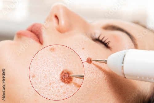 Electrocoagulation and laser cosmelotogy. Dermatologist using a professional electrocautery for removing mole. Zoomed area of melanoma