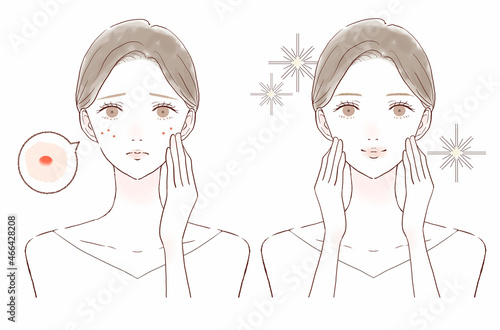 ニキビを気にする女性のビフォーアフター