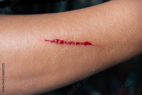 Billede på lærred Arm bleeding from scratch