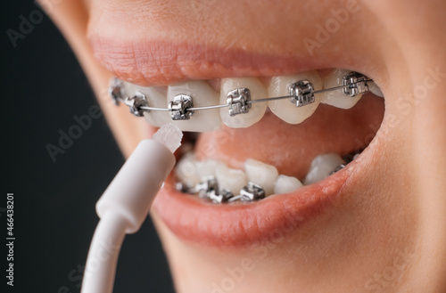 Smiling young woman with braces cleaning her teeth with oral irrigator, close-up. Dental hygiene concept.