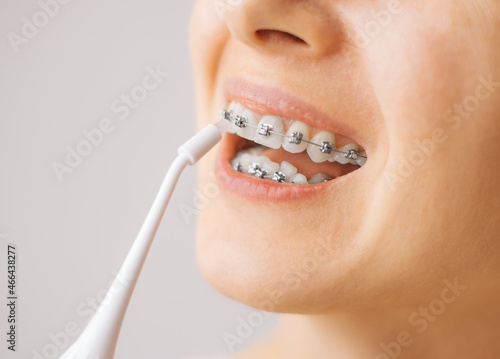 Smiling young unrecognizable woman with braces cleaning her teeth with oral irrigator, close-up. Dental hygiene.