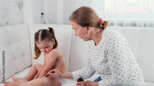 Little girl with chickenpox, antiseptic cream applied to rash. Mother applying antiseptic cream on sad little girl with chickenpox at home