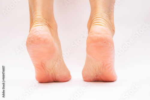 Female feet with cracks and peeling on heels isolated on a white background. Fungal skin infections, allergic diseases, eczema, psoriasis, keratodermia, hyperkeratosis,vitamin deficiency, avitaminosis photo