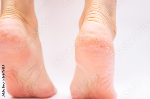 Close-up of female feet with cracks and peeling on heels isolated on a white background. Fungal skin infections, allergic diseases, eczema, psoriasis, keratodermia, hyperkeratosis, vitamin deficiency © Марина Демешко