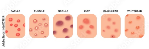 Acne types. Facial infections, pimples and skin inflammation. Skincare, face acne breakout. Dermatology epidermis disease recent vector set