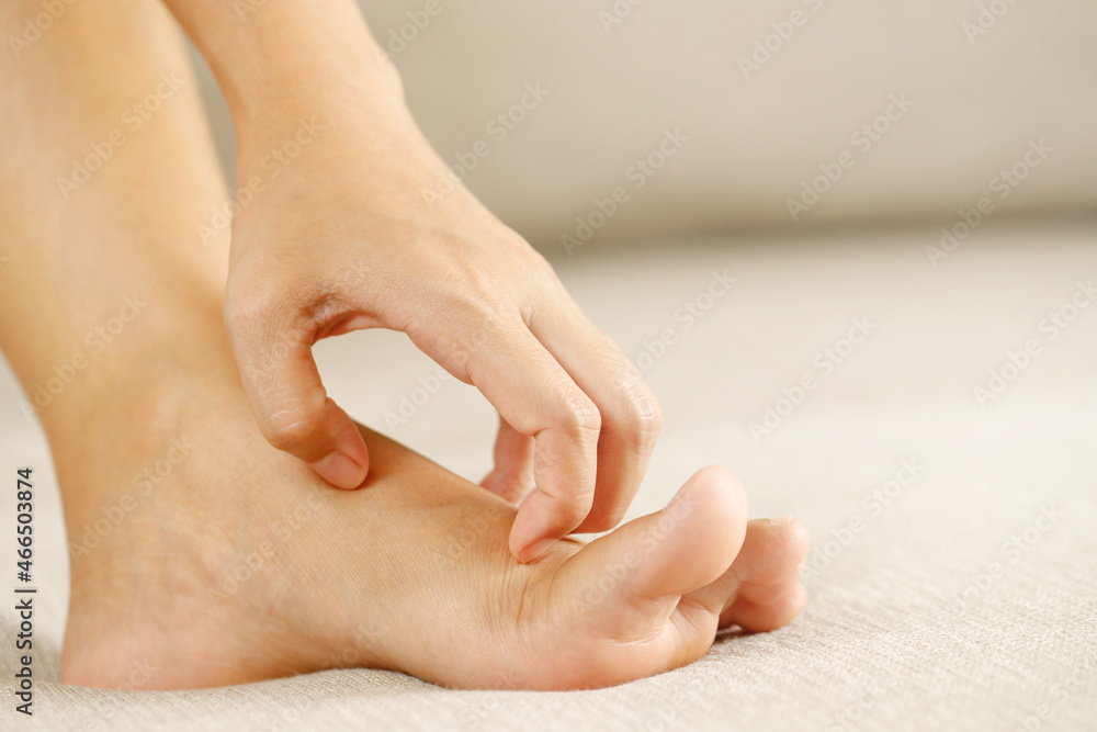Fungal foot itching caused by biting feet Fungal foot itching caused by biting feet