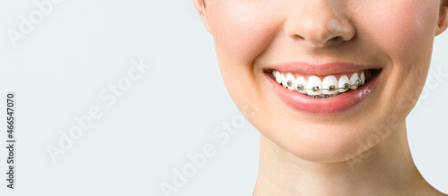 Orthodontic treatment. Dental care concept.Healthy smile close up. Closeup ceramic and metal brackets on teeth. Beautiful female smile with braces.
