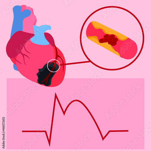 Heart attack illustration. The illustration depicts ECGs for myocardial infarction, coronary artery thrombosis and myocardial necrosis.