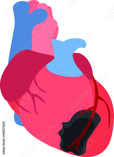 Illustration depicting myocardial infarction as a result of the formation of coronary artery thrombosis. Acute coronary syndrome. Heart disaster. Myocradial muscle necrosis. Emergency cardiology.