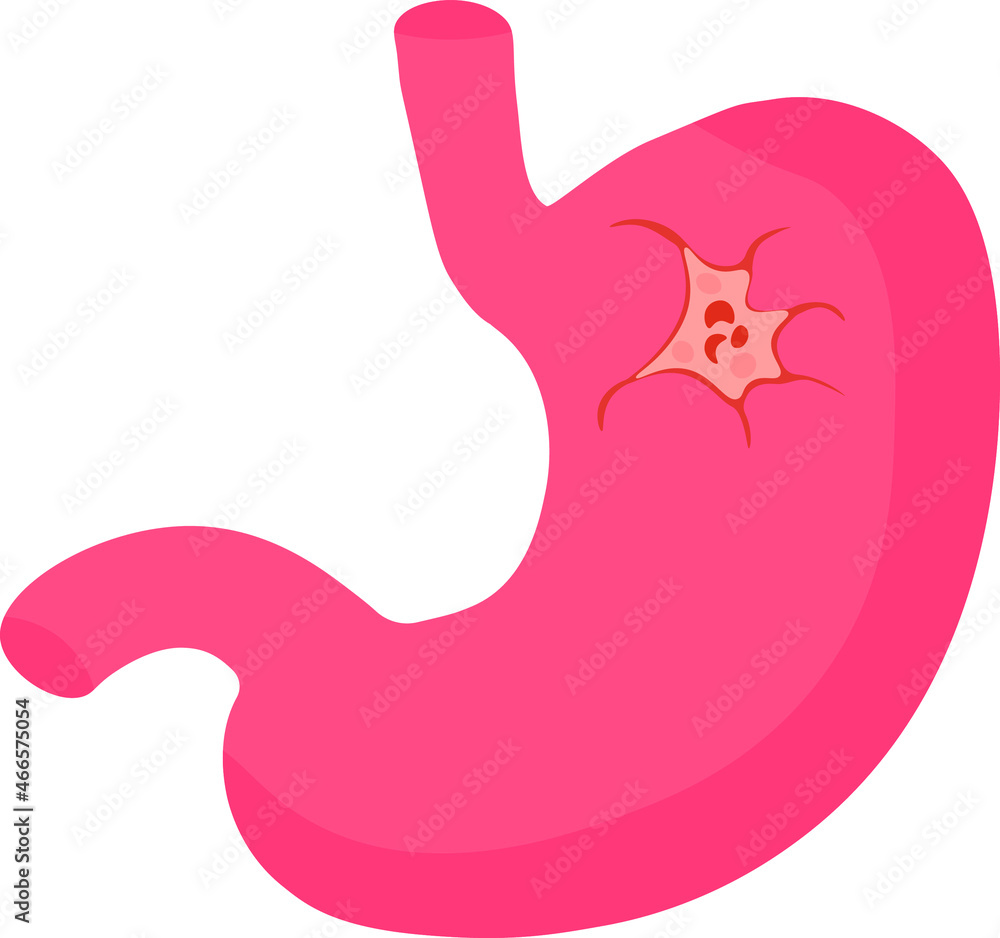 Illustration of the formation of stomach ulcers due to Helicobacter