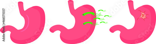Illustration of the formation of stomach ulcers due to Helicobacter pylori. Gastroenterological disease. Gastritis and ulcers of the stomach and duodenum.