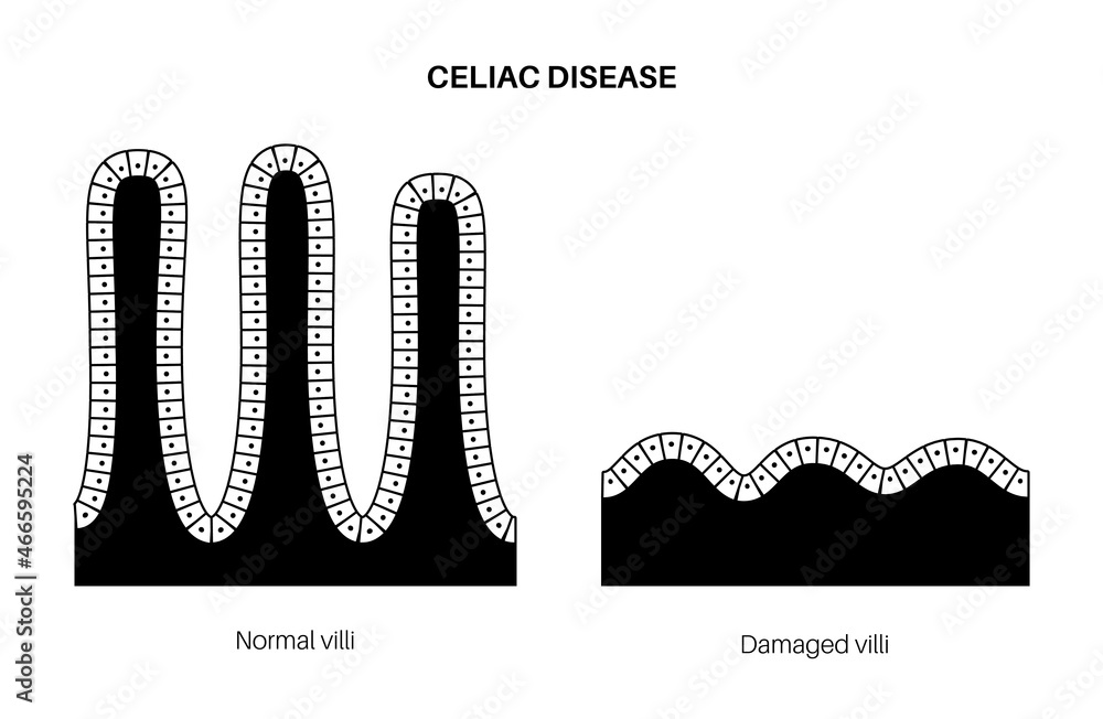 Celiac disease inflammation