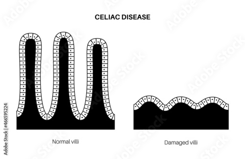 Celiac disease inflammation