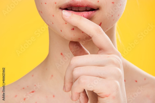 female face closeup red dots dermatology rash