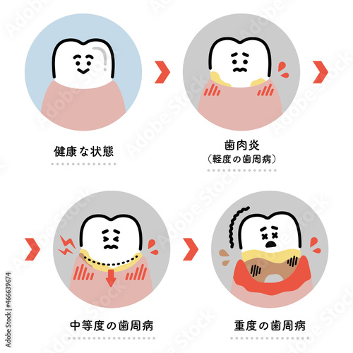 歯周病の進行　イラストセット（日本語ver.） photo