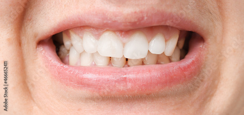 Mouth with white teeth, malocclusion, health problem. Close-up occlusion, misalignment. photo