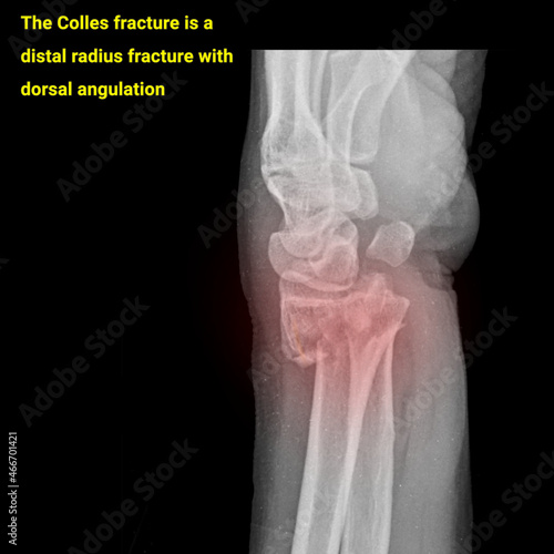 x ray of a colles fracture broken hand photo