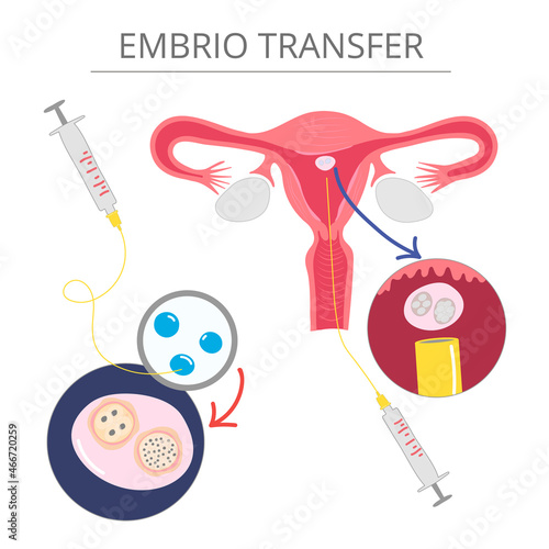 vector illustrations for gynecology. In vitro fertilization treatment of infertility, ovary cycle strokes, and font expended. 