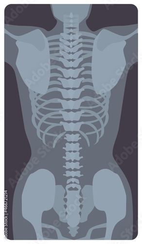 Anterior radiograph of human rib cage and pelvis. X-ray picture or radiographic image of bones and joints, front view. Medical diagnostics. Monochrome vector illustration in flat cartoon style photo