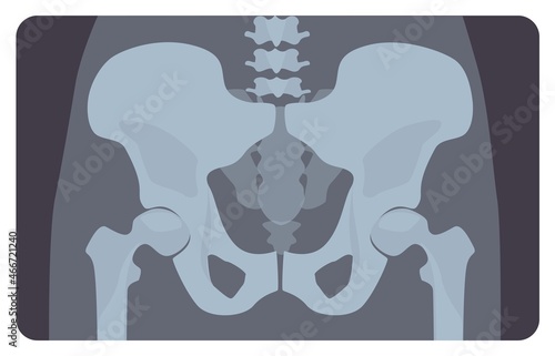 Anterior radiograph of human pelvis or hip bone with lumbar part. X-ray picture or image of human skeletal system, front view. Medical disease detection. Vector illustration in flat cartoon style