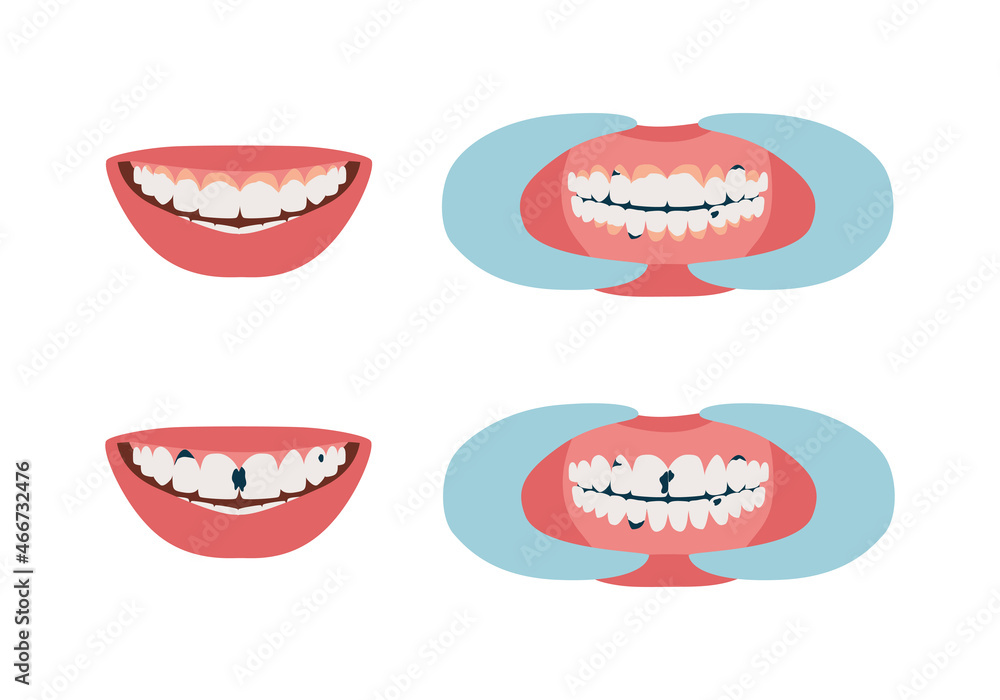 Oral cavity with tartar, plaque and caries. Smile with aching teeth. Dentistry, dental treatment. Set of isolated vector illustrations Oral cavity with tartar, plaque and caries. Smile with aching teeth. Dentistry, dental treatment. Set of isolated vector illustrations