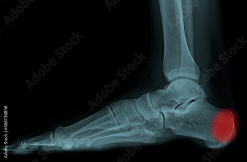 lateral x-ray of foot and ankle. the film show normal bone and joint. the patient has Achilles tendinitis and retrocalcaneal bursitis. photo