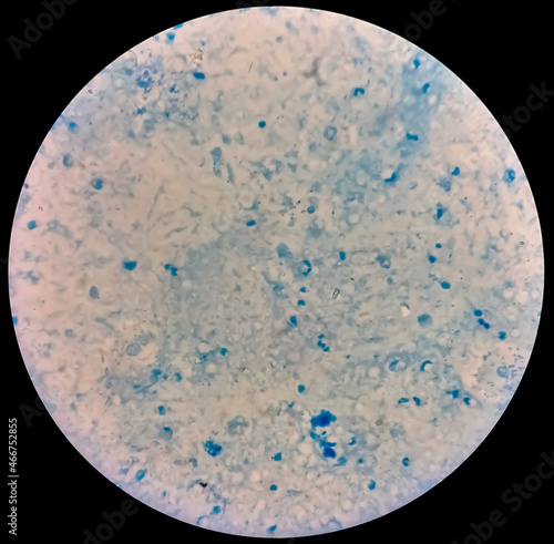 Sputum smear under microscopy showing gram positive cocci bacteria. Smear of Gram's stained from sputum specimen