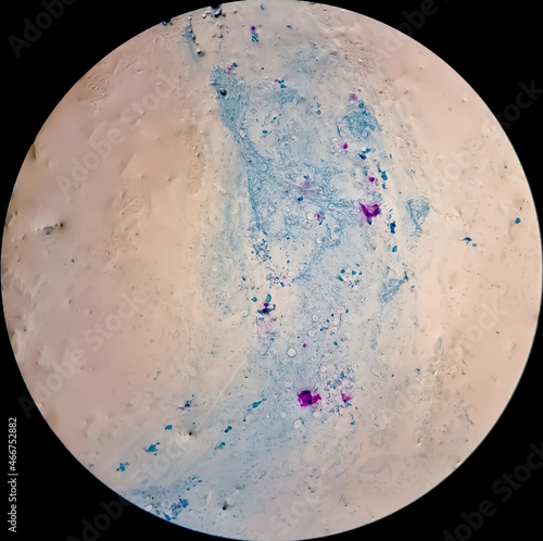 Sputum smear under microscopy showing gram positive cocci bacteria. Smear of Gram's stained from sputum specimen photo