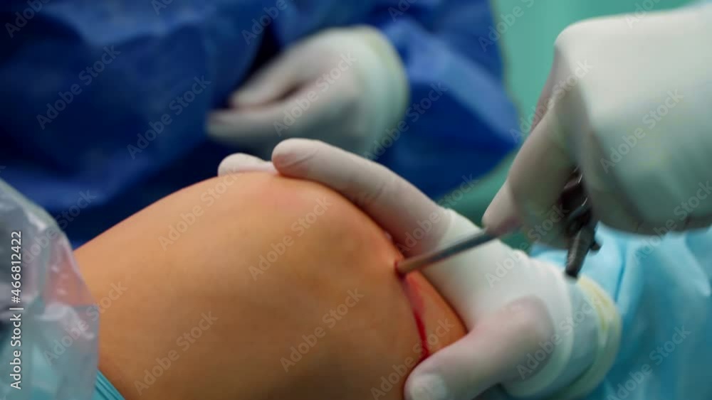 the surgeon places the camera in the patient's knee the surgeon places the camera in the patient's knee