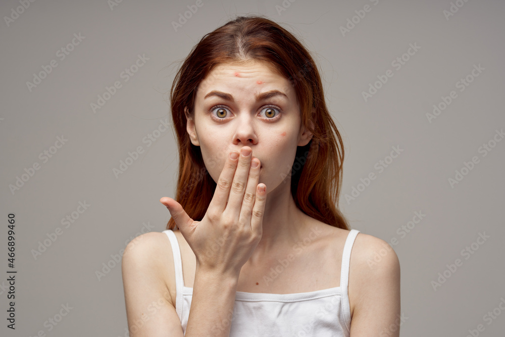 beautiful woman with pimples on the face hygiene light background beautiful woman with pimples on the face hygiene light background