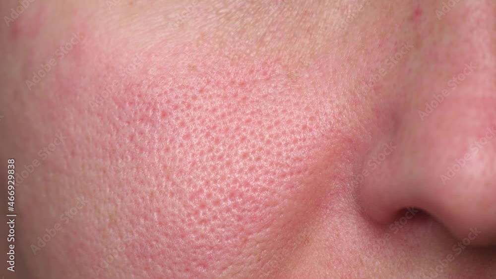 Macro skin texture, enlarged pores. Part of a woman's face. Problem skin, irritation. Irritation on the face. Macro skin texture, enlarged pores. Part of a woman's face. Problem skin, irritation. Irritation on the face.